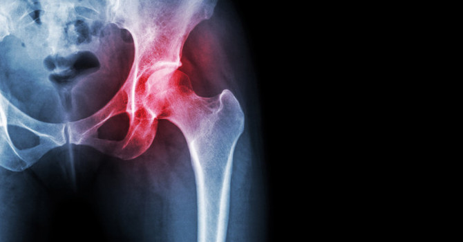 Chiropractic Care for Osteoarthritis image