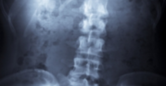 Scoliosis image